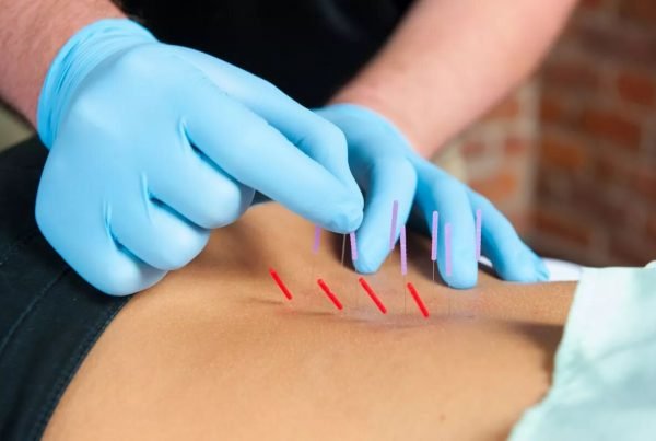 Imagen de un terapeuta realizando punción seca para aliviar puntos gatillo en terapia de punción seca